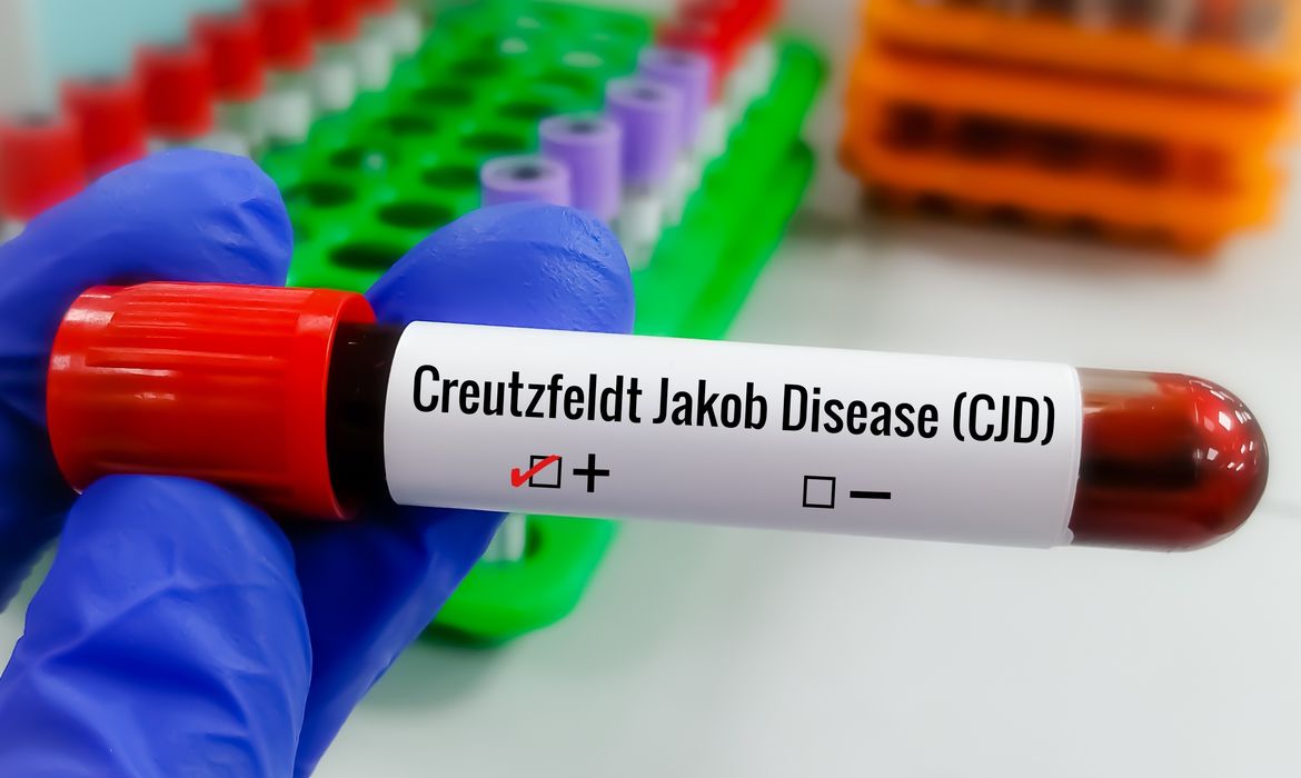 Creutzfeldt-Jakob: por que o diagnóstico especializado é importante